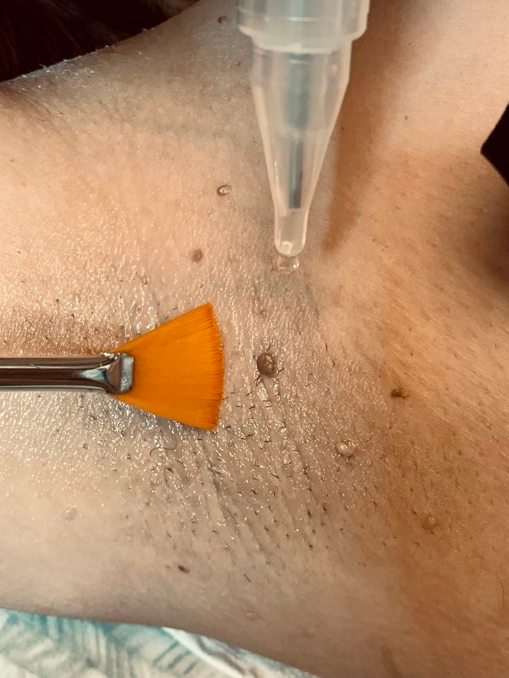 Wart Removal