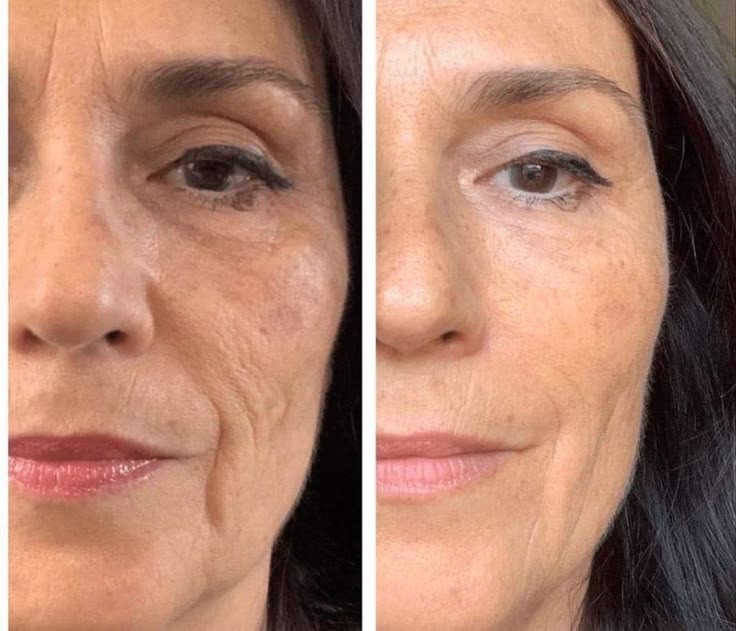 Anti Aging Facial