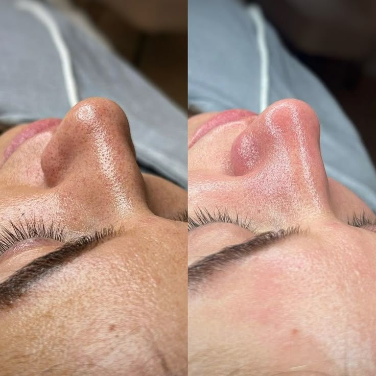 Dermaplaning