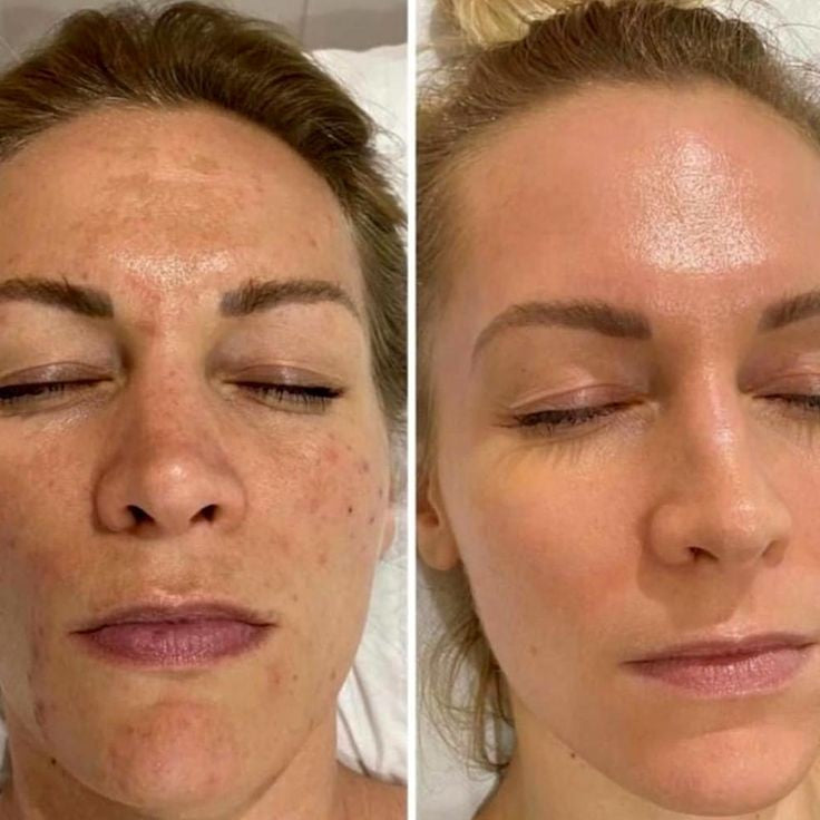 Microdermabrasion