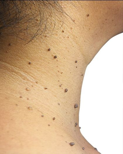 Wart Removal