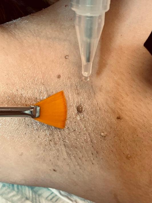 Wart Removal